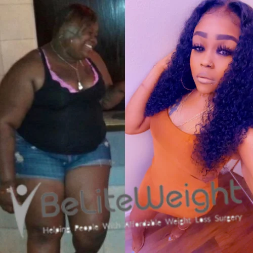 Weight Loss Surgery Before And After